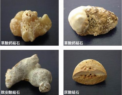 腎結石不同成分的解說