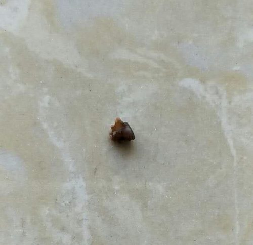 五絕指針治療右側(cè)輸尿管末端結(jié)石